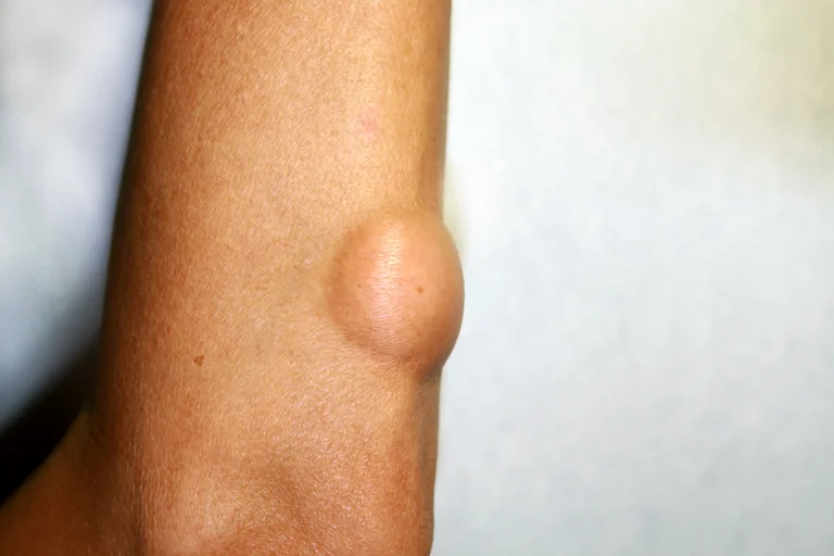 Lipom im Arm