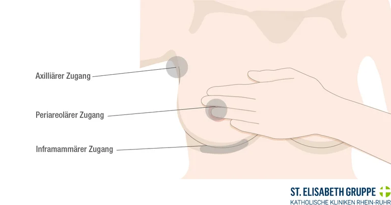 Darstellung der verschiedenen Schnitttechniken zur Brustvergrößerung