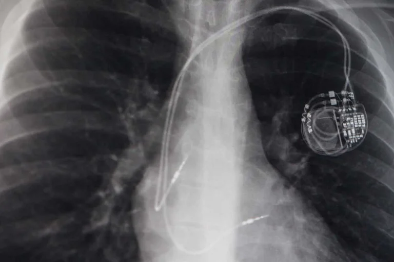 Klassischerweise wird ein Herzschrittmacher operativ unter der Haut eingebaut, wenn das Herz eines Patienten aufgrund einer Erkrankung zu langsam schlägt.