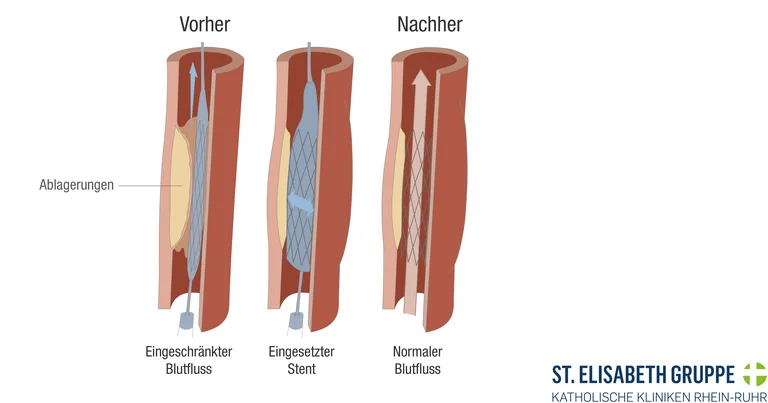 Illustration eines Halsgefäßes mit Carotisstenose: links Verengung durch Plaque mit eingeschränktem Blutfluss, Mitte Stent wird eingesetzt, rechts geöffnete Arterie mit normalisiertem Blutfluss.