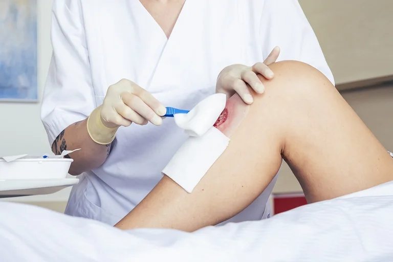 Pflegefachkraft versorgt die Wunde einer Patientin mit modernen Wundauflagen – professionelle Wundbehandlung im klinischen Umfeld.