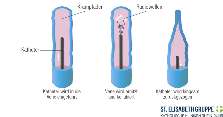endovenöse Radiowellenbehandlung