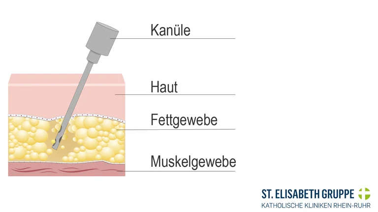 Liposuktion Kanüle saugt Fettgewebe ab
