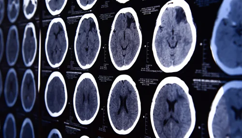 CT-Scan des Gehirns