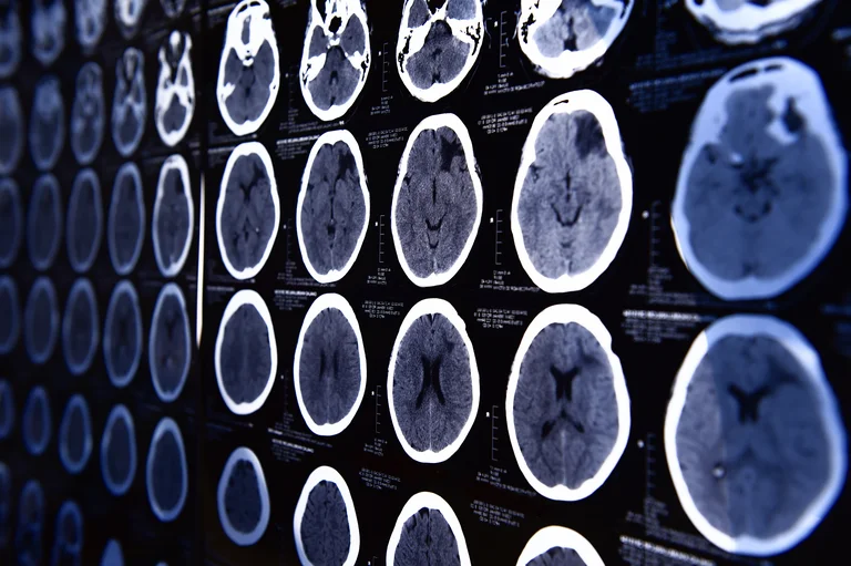CT-Scan des Gehirns