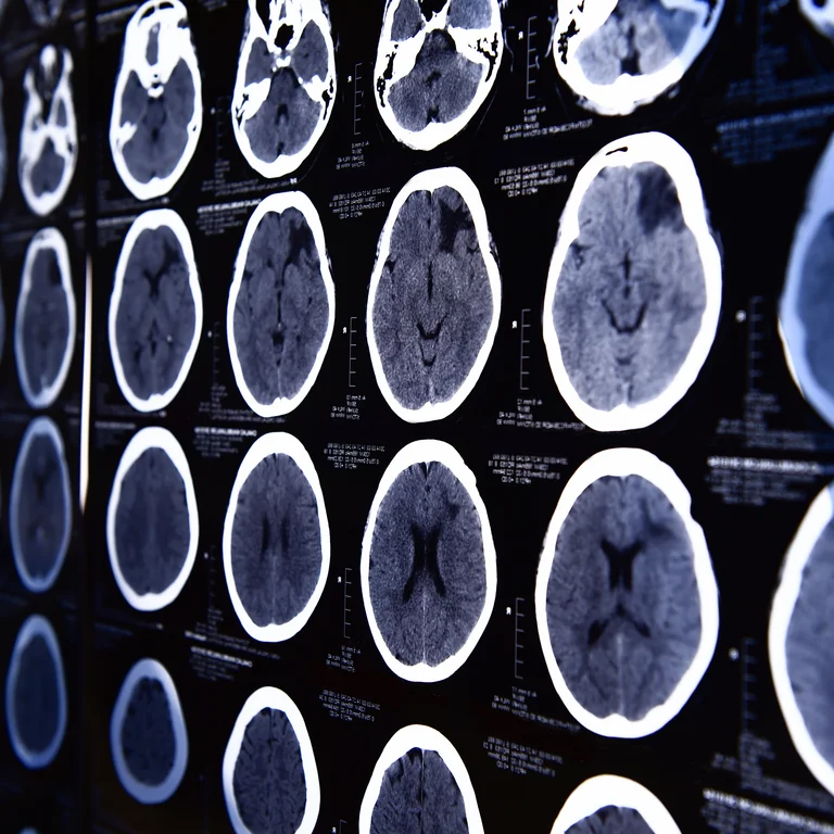 CT-Scan des Gehirns