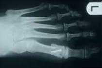 Radiologisches Bild nach Chevron Osteotomie