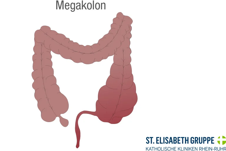 Ein toxisches Megakolon ist eine seltene Komplikation der Colitis ulcerosa.