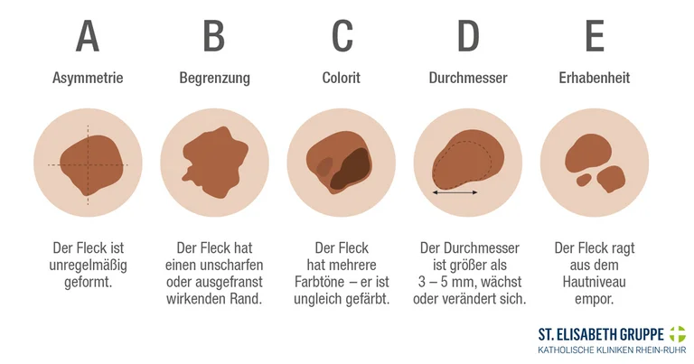 ABCDE-Regel zur Selbsteinschätzung des Risikos für Hautkrebs