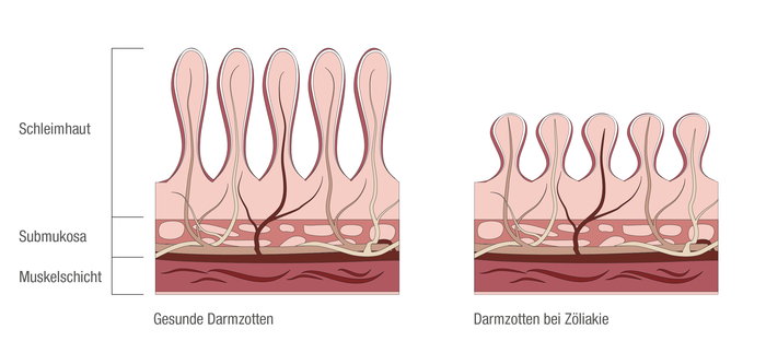 Schematische Darstellung von Darmzotten: Bei Zöliakie werden die Darmzotten zerstört.
