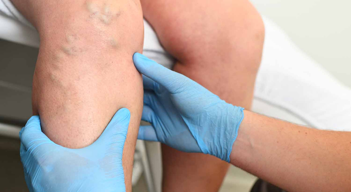 Tiefe Venenthrombose der Beinvenen