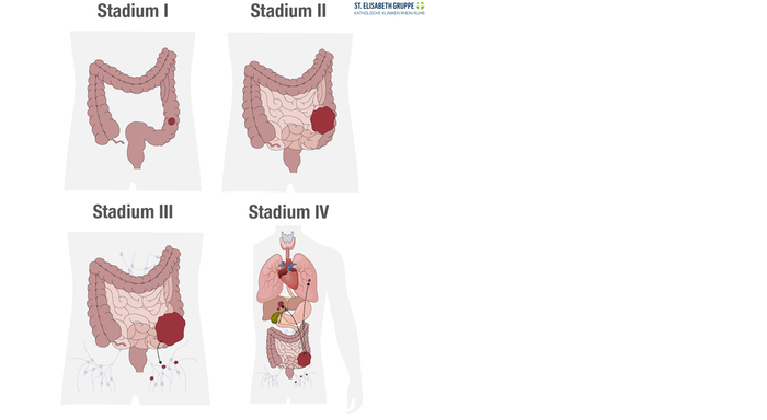 Mit dem Krankheitsstadium (Stadium I, II, III oder IV) kann die Ausbreitung von Darmkrebs beschrieben werden.