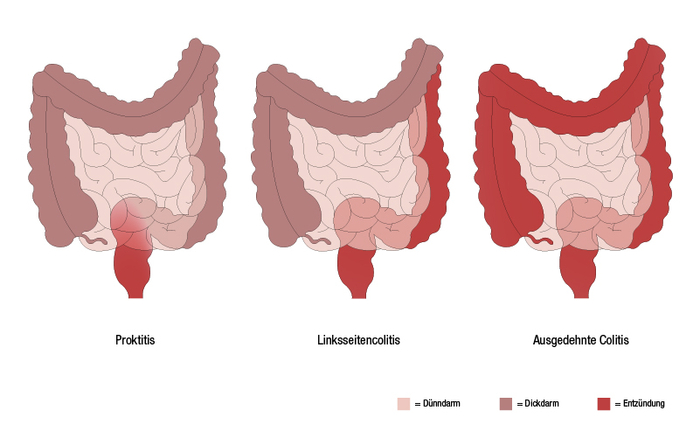 Grafische Darstellung der Unterscheidung verschiedener Schweregrade einer Colitis ulcerosa