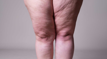 Typische Beine einer Lipödem-Betroffenen. Eine Liposuktion kann hier helfen. Im Marien Hospital Witten wird diese in allen drei Lipödem-Stadien angeboten (© staras – stock.adobe.com)