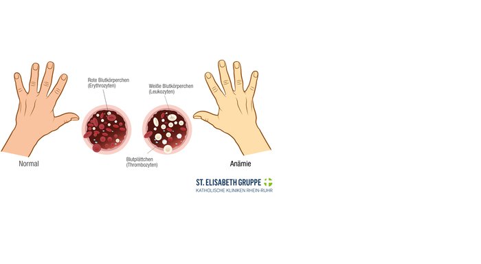 Blutarmut (Anämie) durch einen chronischen, unbemerkten Blutverlust, kann ein Anzeichen für Darmkrebs sein.