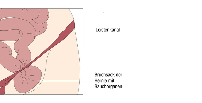 Leistenbruch - Hernie mit Bruch im Leistenband Infografik