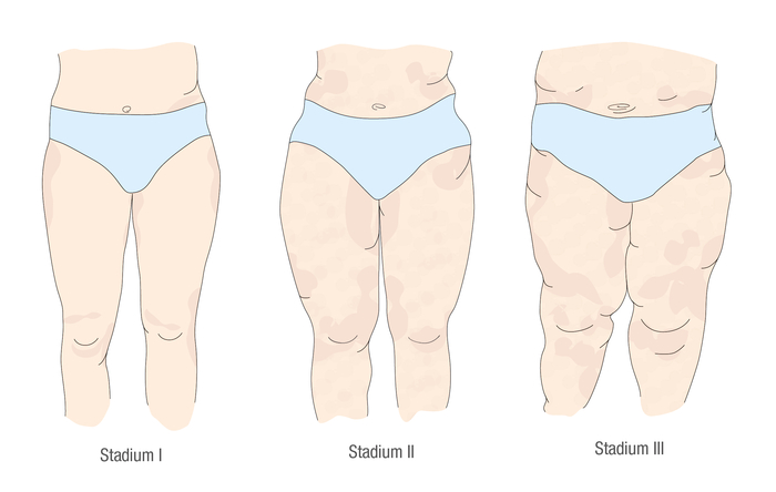 Die drei Stadien eines Lipödem