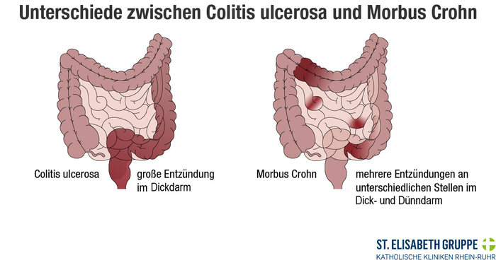 Grafik, die die Unterschiede zwischen Colitis ulcerosa und Morbus Crohn zeigt