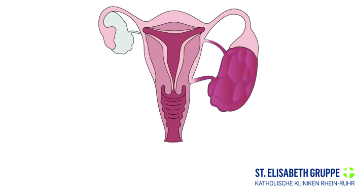 Grafische Darstellung Eierstockkrebs