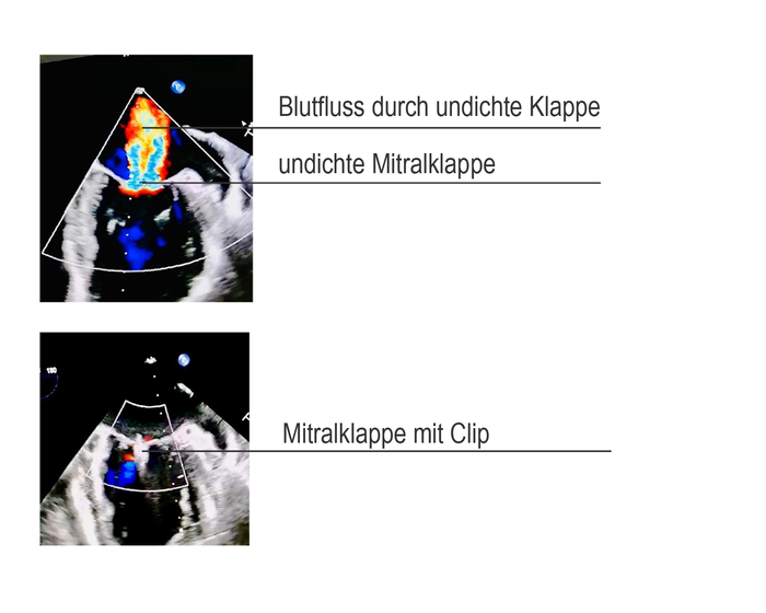 Mitralklappe mit und ohen Clip Ultraschallaufnahme
