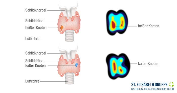 Medizinische Darstellung von heißen und kalten Schilddrüsenknoten.