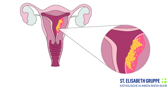 Gebärmutterkrebs (Endometriumkarzinom) ist eine Krebserkrankung der Gebärmutterhöhle