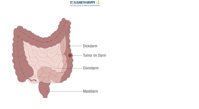 Darmkrebs kann als Dünndarmkrebs, Dickdarmkrebs oder Mastdarm-/Enddarmkrebs auftreten.