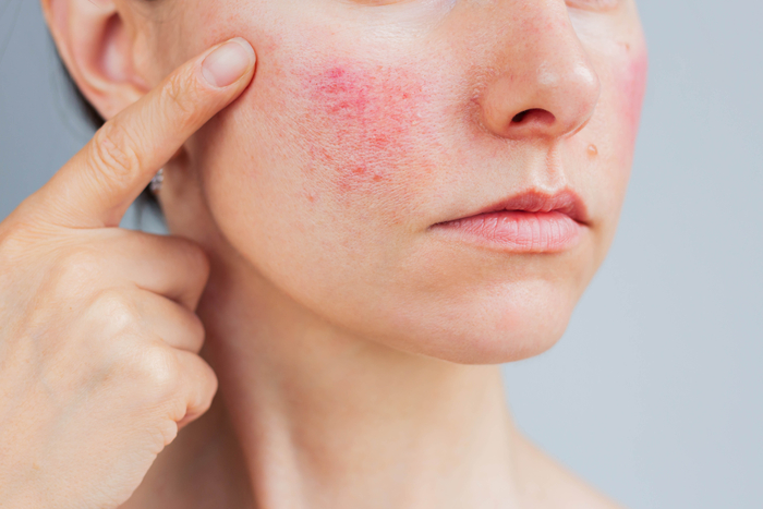 Frau mit Rosacea auf den Wangen