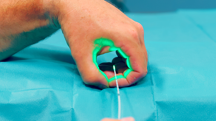 Die feine Lasersonde wird bei dem FiLaC-Verfahren in den After eingeführt, um die Analfissur dort gezielt mit Wärmeenergie zu zerstören.