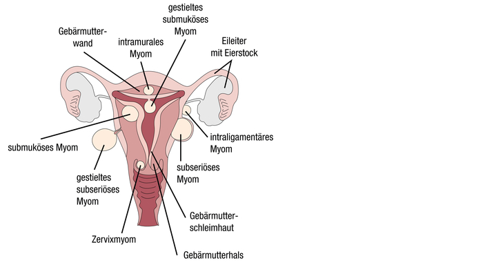 Grafik der verschiedenen Myom-Arten