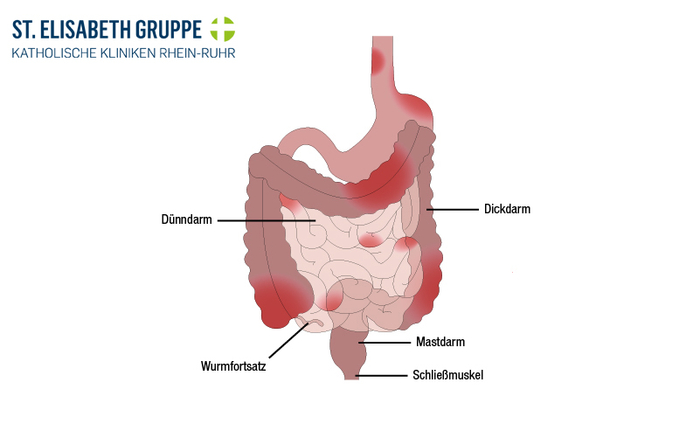Grafik des Verdauungstrakt mit durch Morbus Crohn entzündete Stellen