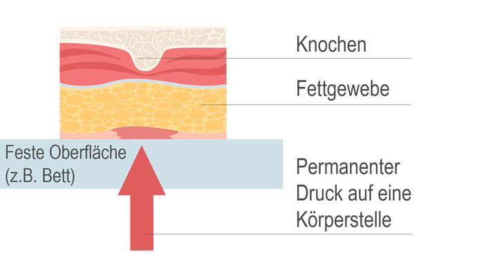 ein Dekubitus entsteht durch permanenten Druck auf eine bestimmte Körperstelle