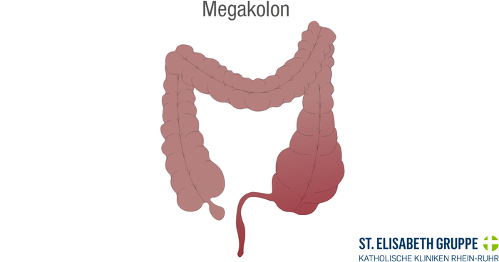 Grafische Darstellung eines toxischen Megakolons infolge einer Colitis ulcerosa