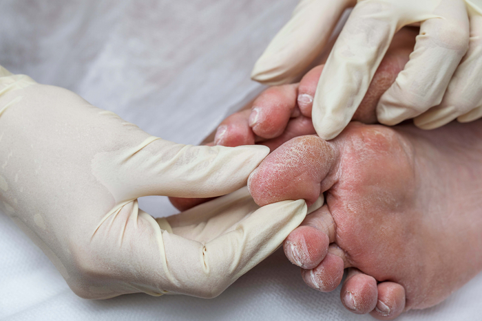 Diabetischer Fuß: Trockene, rissige Hautstellen