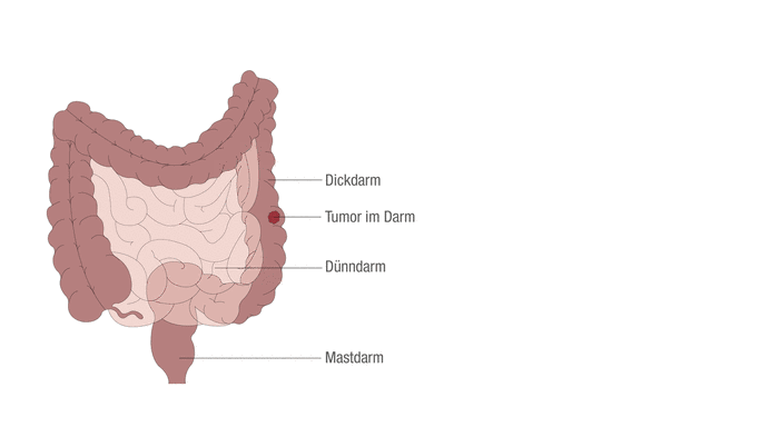 Darmkrebs kann als Dünndarmkrebs, Dickdarmkrebs oder Mastdarm-/Enddarmkrebs auftreten.