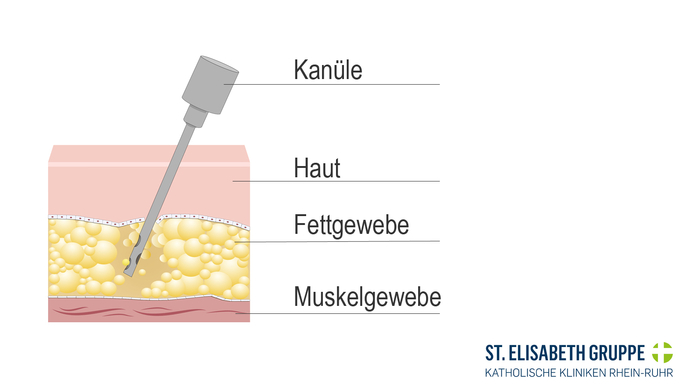 Liposuktion Kanüle saugt Fettgewebe ab