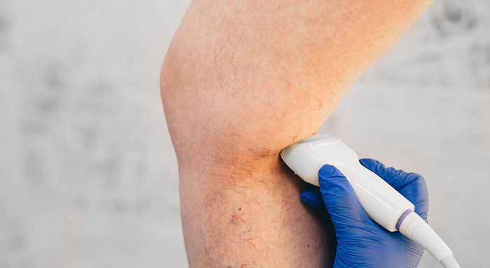 Ultraschalluntersuchung am Bein, um Krampfadern zu diagnostizieren.