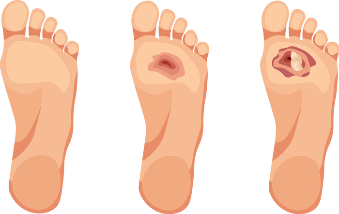 Grafische Darstellung des diabetischen Fußsyndroms