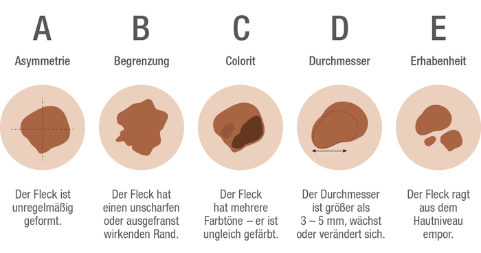 Grafische Darstellung der ABCDE-Regel zur Unterscheidung von gutartigen Hauttumoren und Hautkrebs