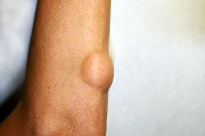 Lipom im Arm