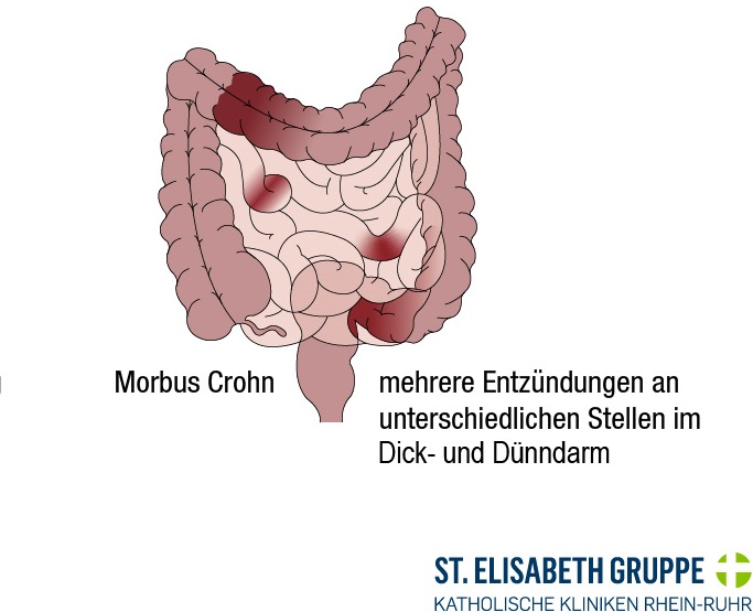 Morbus Crohn: Grafik eines Darms mit mehreren entzündeten Stellen